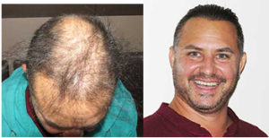 Artificial hair implant Besthetics 