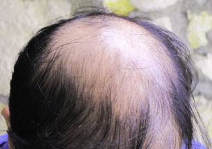 Biofibre Hair Implant - Besthetics 